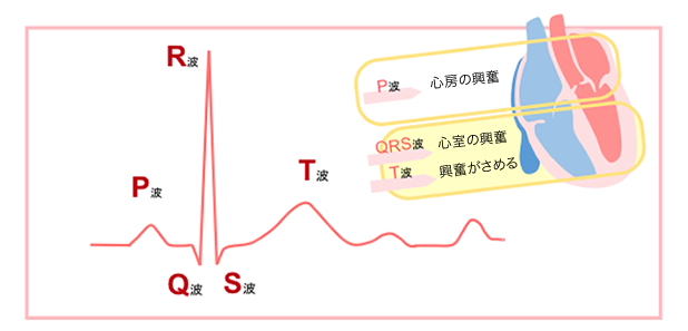 心室性期外収縮